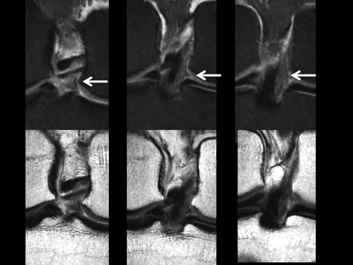 Figure 3 for case posteromedial bundle of posterior cruciate ligament ( RID2786 )